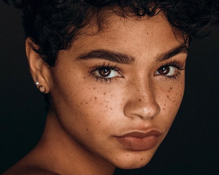 freckles