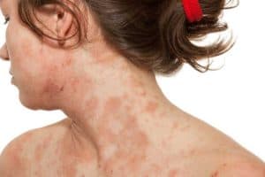 Read more about the article What is Atopic Dermatitis in Adults?