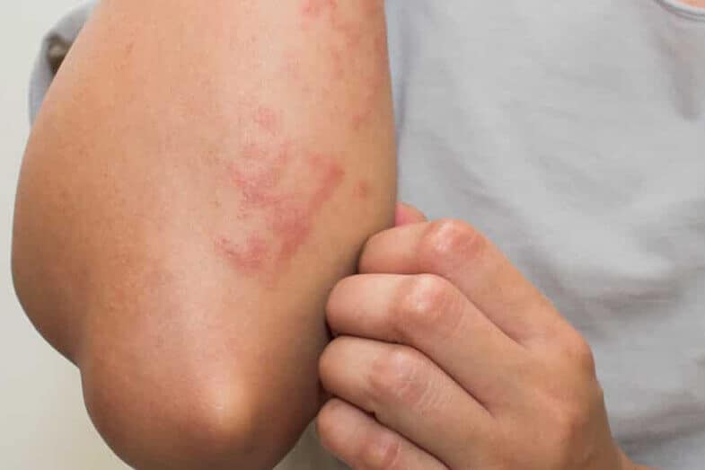 How Long Does Skin Allergy Last?