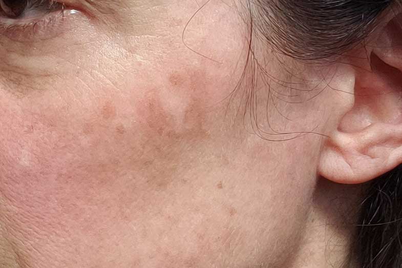 Why Is My Skin Turning Black? 4 Causes