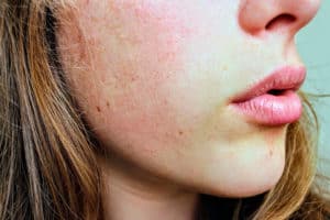 Read more about the article Types of Skin Problems on Face – Top 10 List