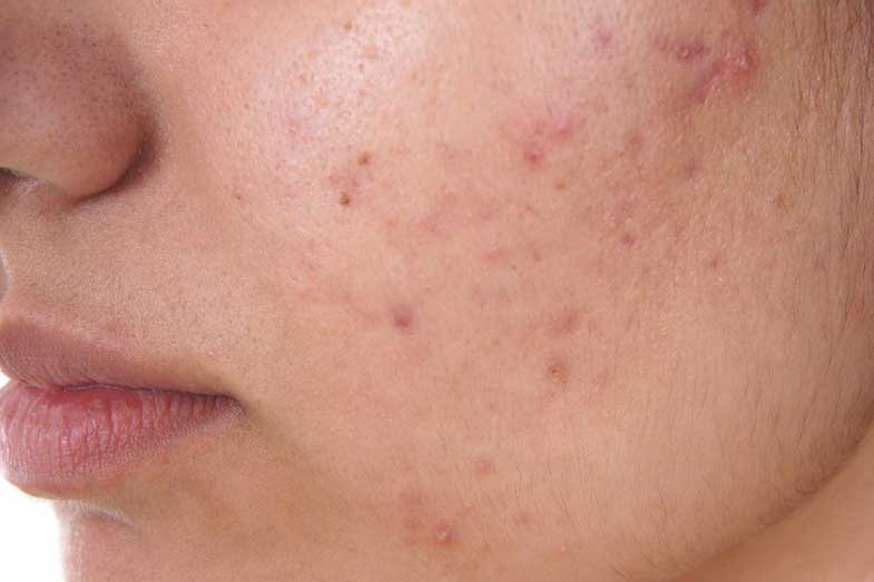 How Long Does Purging Acne Last