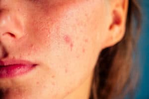 Read more about the article Why Does Acne Take so Long to Heal?