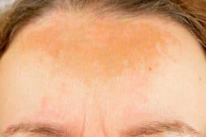 Read more about the article Why Is My Skin Getting Darker Without Sun?