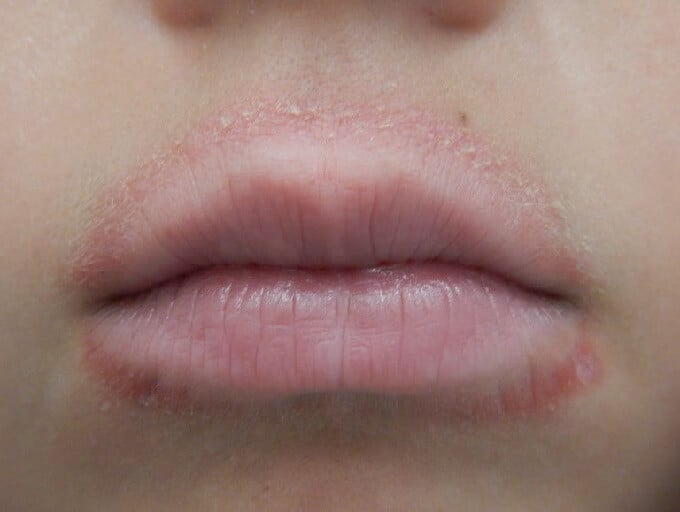 dry skin on upper lip