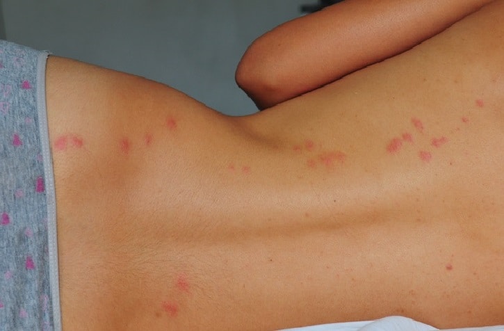 how to get rid of bug bites on skin