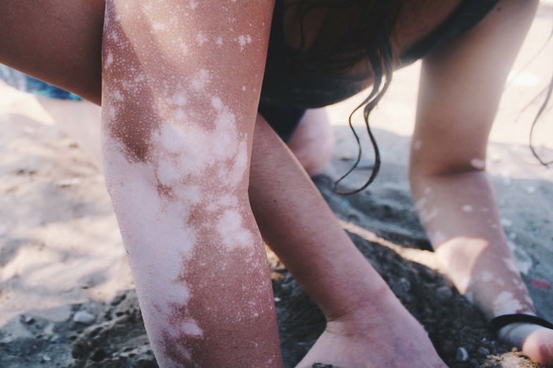 interesting facts about vitiligo