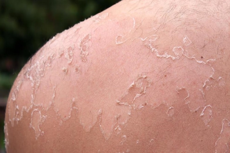 How Long Does Skin Peel After a Sunburn?