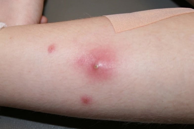 bacterial-skin-rash