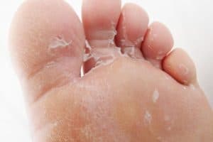 Read more about the article Bottom of Feet Peeling: Causes and Treatments