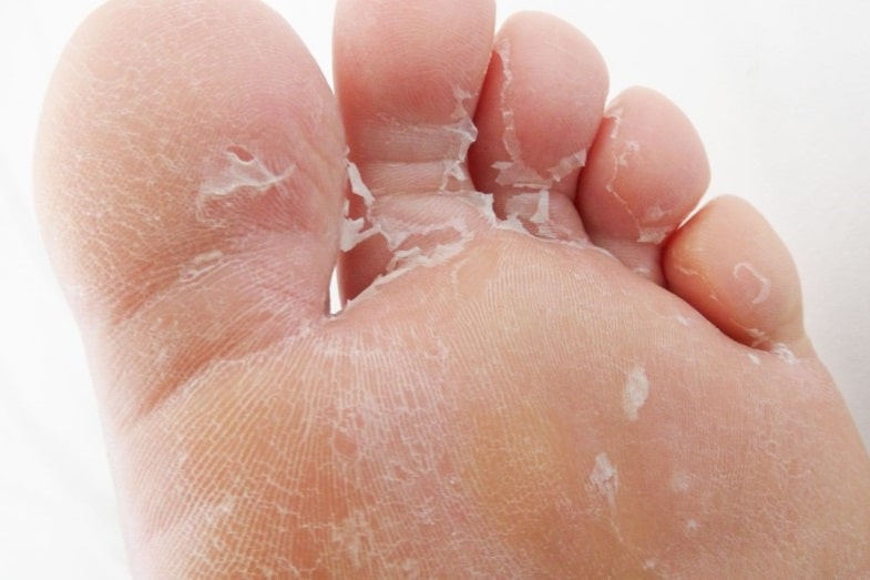 dry peeling feet