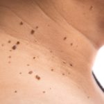 How Long Does It Take for a Skin Tag to Fall Off?