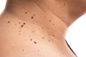 Read more about the article How Long Does It Take for a Skin Tag to Fall Off?
