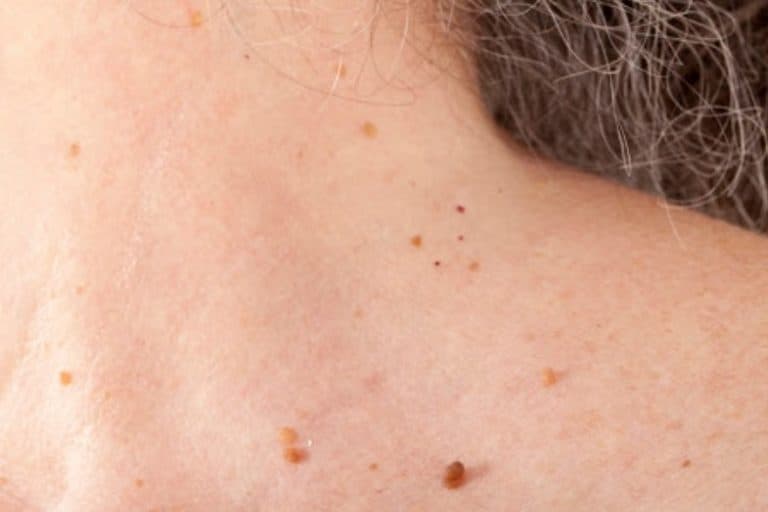 Yellow Spots on Skin: Causes and Treatments - Skin Care Geeks