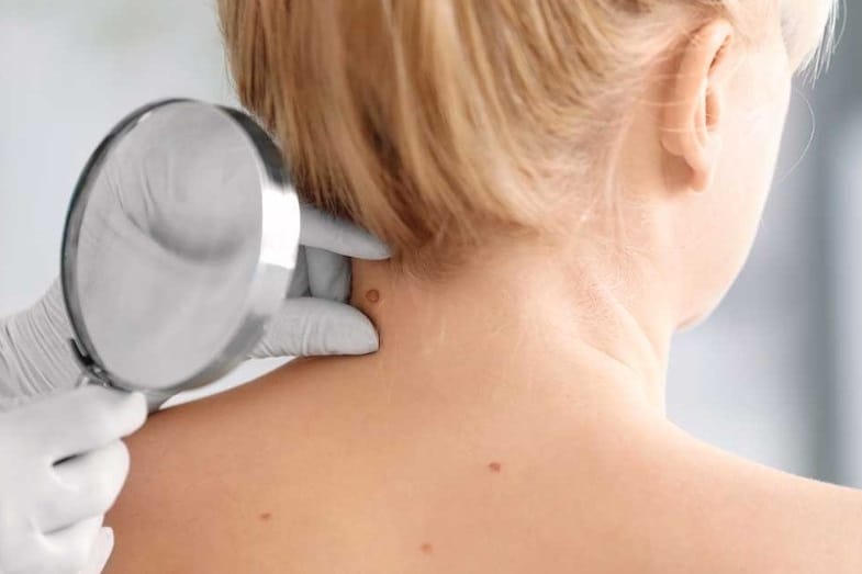 how to get rid of skin tags on neck