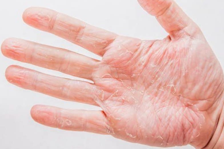 Treatment hands chapped best dry for Dry Hands: