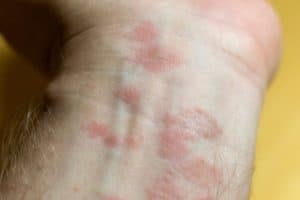 Read more about the article Pink Spots on Skin: Causes and Treatments