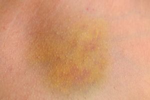 Read more about the article Yellow Spots on Skin: Causes and Treatments