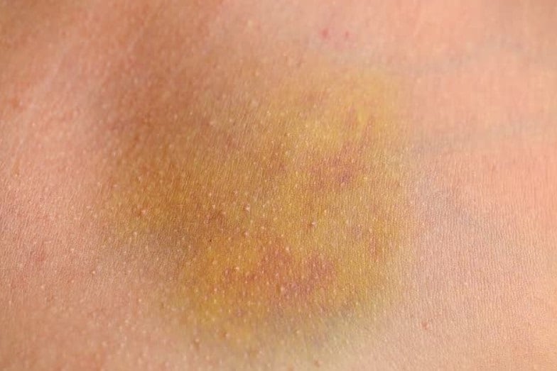 Yellow Spots On Skin Meaning at Brandon Harding blog