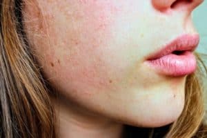 Read more about the article Uneven Skin Tone – How to Even It Out? 11 Tips