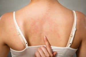 Read more about the article Accutane Eczema [Is Accutane Good or Bad for Eczema?]