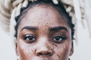 Read more about the article Hyperpigmentation Treatment for Black Skin