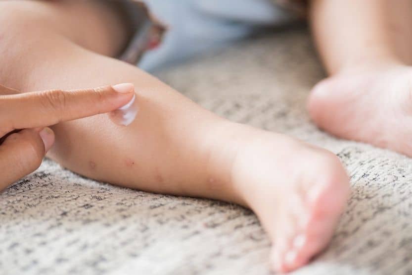 calamine lotion for eczema on babies