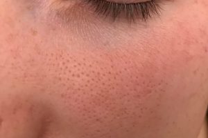Read more about the article Holes in Face (Pores or Pockmarks) – How to Minimize