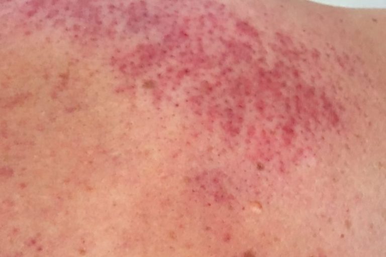 colchicine pinpoint red spots on skin