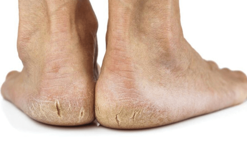 how to get rid of dead skin on feet