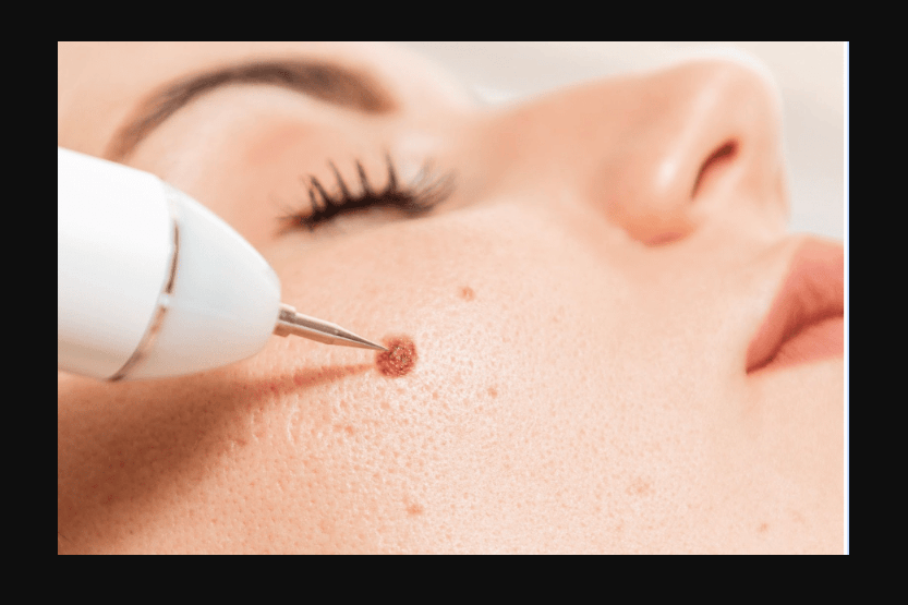 how to get rid of moles on skin
