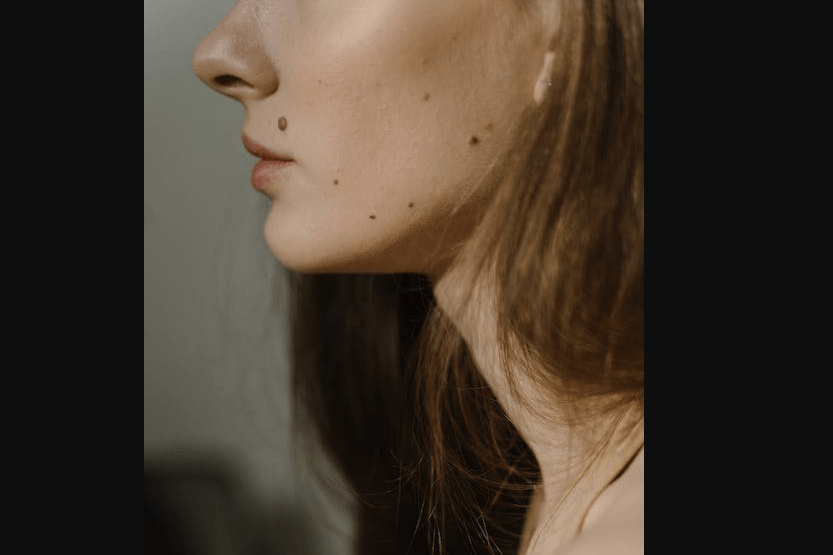 how to get rid of moles on skin