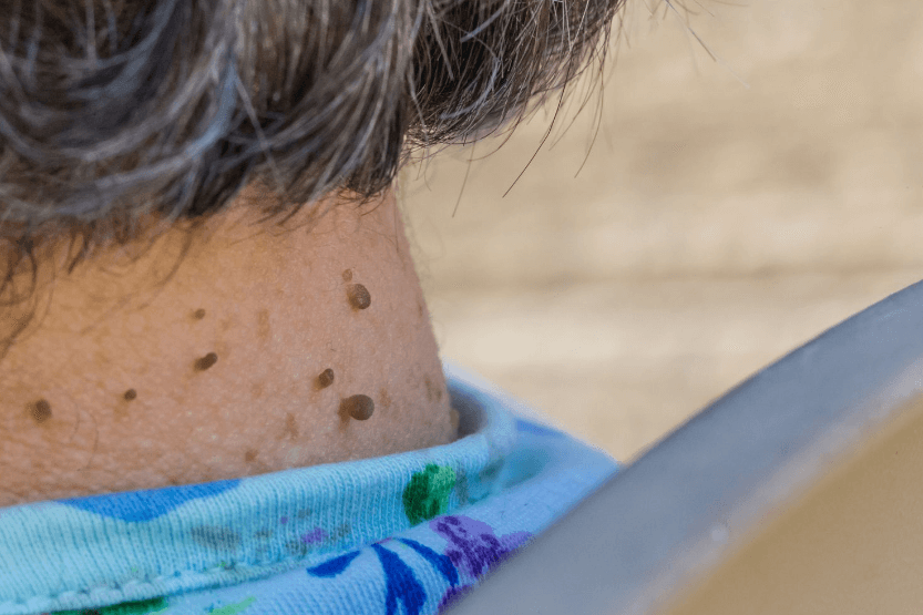 what causes skin tags on neck