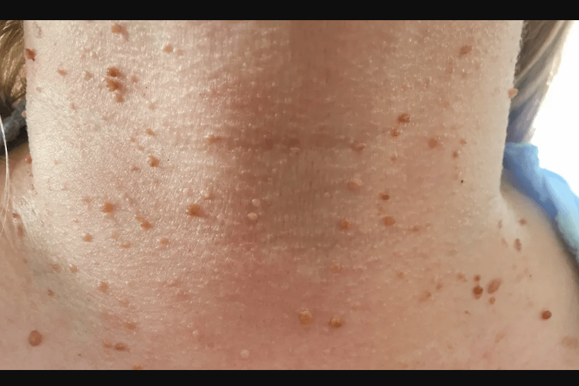 what causes skin tags on neck