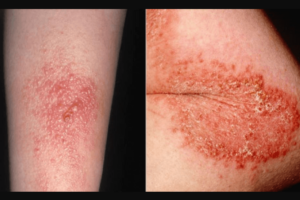 Read more about the article What Does Poison Ivy Look Like on Skin? A Helpful Guide