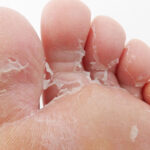 How to Fix Peeling Skin on Feet
